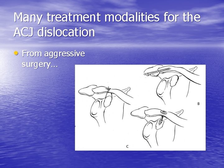 Many treatment modalities for the ACJ dislocation • From aggressive surgery… 