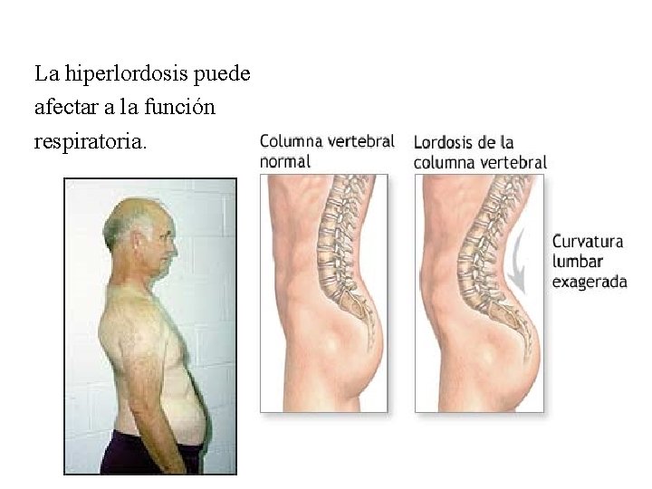 La hiperlordosis puede afectar a la función respiratoria. 
