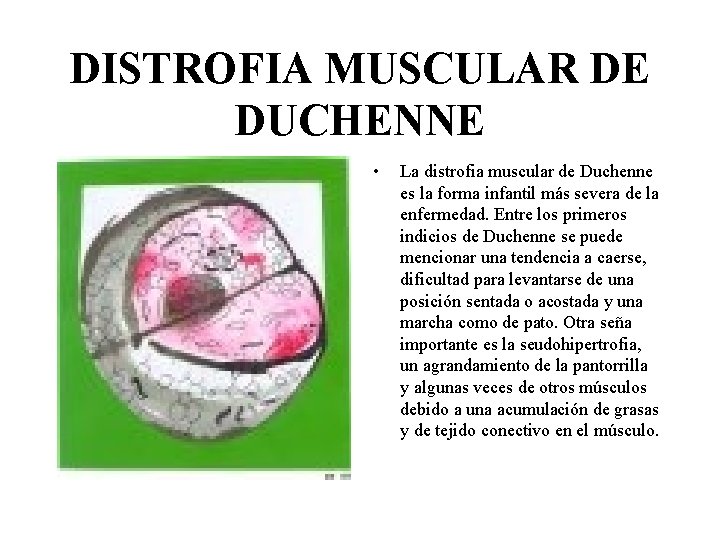 DISTROFIA MUSCULAR DE DUCHENNE • La distrofia muscular de Duchenne es la forma infantil