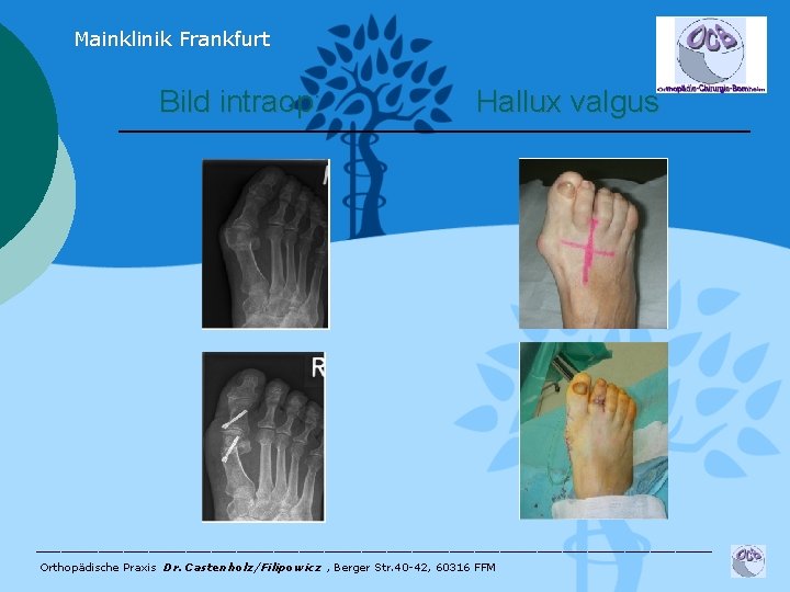 Mainklinik Frankfurt Bild intraop: Hallux valgus ___________________________ Orthopädische Praxis Dr. Castenholz/Filipowicz , Berger Str.
