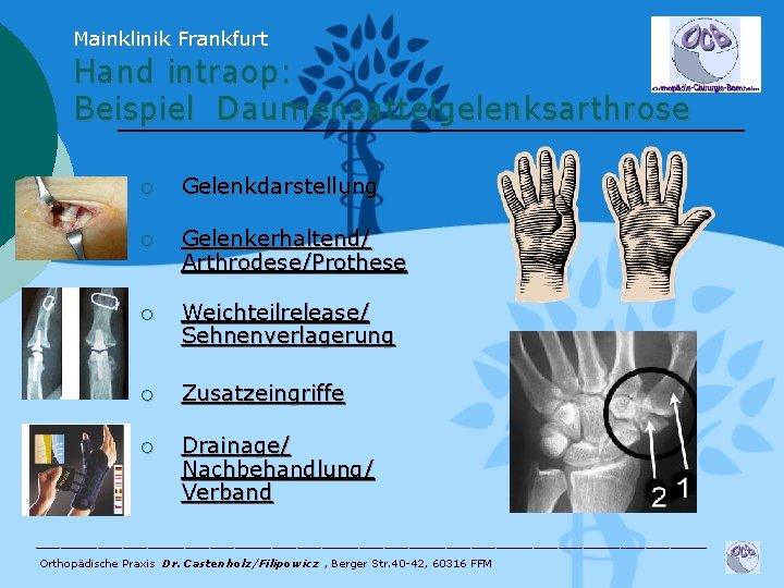 Mainklinik Frankfurt Hand intraop: Beispiel Daumensattelgelenksarthrose ¡ Gelenkdarstellung ¡ Gelenkerhaltend/ Arthrodese/Prothese ¡ Weichteilrelease/ Sehnenverlagerung