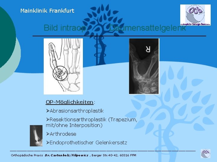 Mainklinik Frankfurt Bild intraop: Daumensattelgelenk OP-Möglichkeiten: ØAbrasionsarthroplastik ØResektionsarthroplastik (Trapezium, mit/ohne Interposition) ØArthrodese ØEndoprothetischer Gelenkersatz
