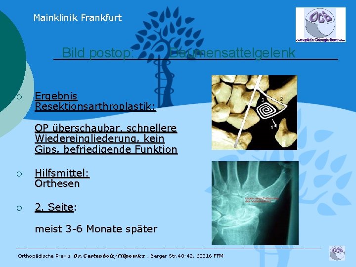 Mainklinik Frankfurt Bild postop: ¡ Daumensattelgelenk Ergebnis Resektionsarthroplastik: OP überschaubar, schnellere Wiedereingliederung, kein Gips,