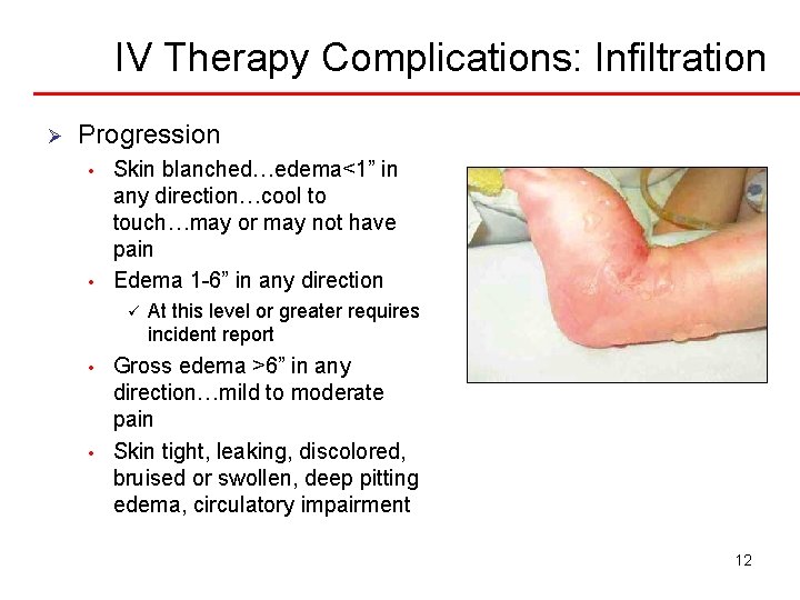 IV Therapy Complications: Infiltration Ø Progression • • Skin blanched…edema<1” in any direction…cool to