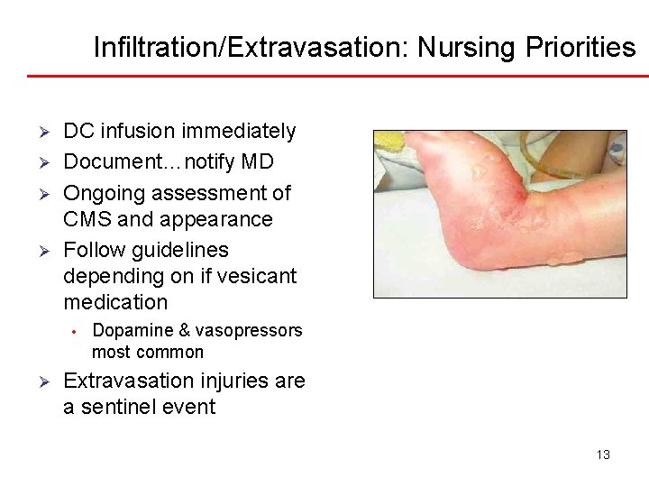 Infiltration/Extravasation: Nursing Priorities Ø Ø DC infusion immediately Document…notify MD Ongoing assessment of CMS