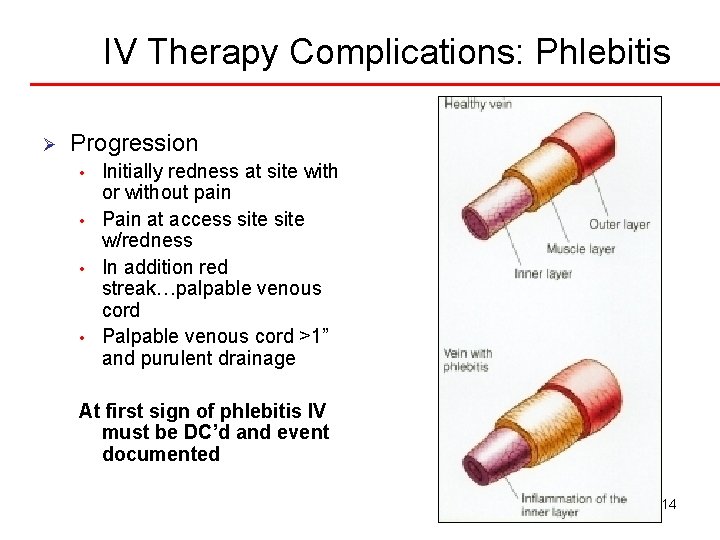 IV Therapy Complications: Phlebitis Ø Progression • • Initially redness at site with or