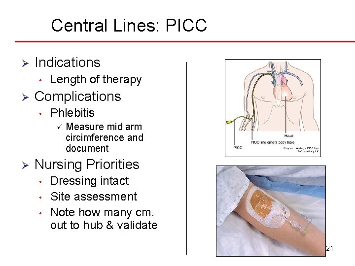 Central Lines: PICC Ø Indications • Ø Length of therapy Complications • Phlebitis ü