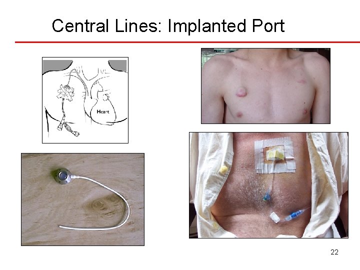 Central Lines: Implanted Port 22 