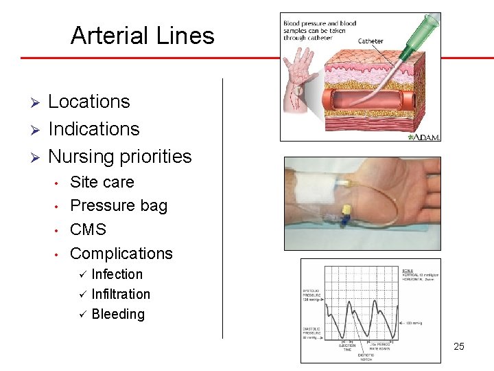 Arterial Lines Ø Ø Ø Locations Indications Nursing priorities • • Site care Pressure