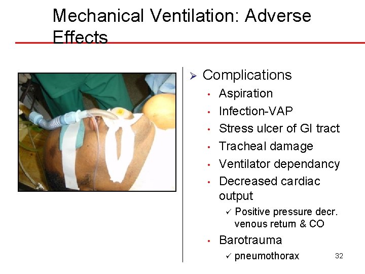 Mechanical Ventilation: Adverse Effects Ø Complications • • • Aspiration Infection-VAP Stress ulcer of