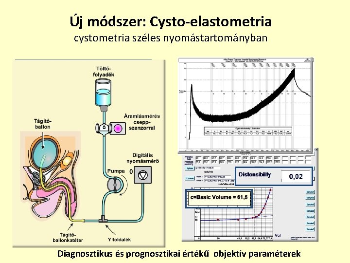 Új módszer: Cysto-elastometria cystometria széles nyomástartományban Diagnosztikus és prognosztikai értékű objektív paraméterek 