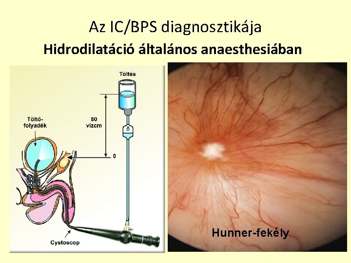 Az IC/BPS diagnosztikája Hidrodilatáció általános anaesthesiában Töltés közben fokozódó nyálkahártya glomerulációk Spirális erek !!!