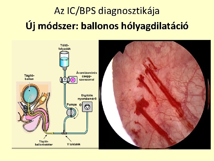 Az IC/BPS diagnosztikája Új módszer: ballonos hólyagdilatáció • Magas intravesicalis nyomás (70 vízcm) •