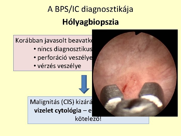 A BPS/IC diagnosztikája Hólyagbiopszia Korábban javasolt beavatkozás • nincs diagnosztikus értéke • perforáció veszélye A BPS/IC diagnosztikája Hólyagbiopszia Korábban javasolt beavatkozás • nincs diagnosztikus értéke • perforáció veszélye