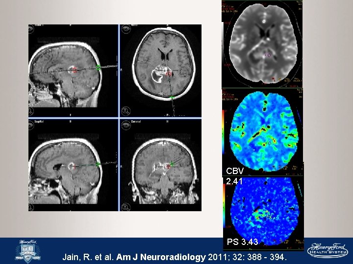 CBV 2. 41 PS 3. 43 Jain, R. et al. Am J Neuroradiology 2011;