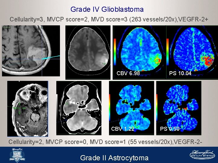 Grade IV Glioblastoma Cellularity=3, MVCP score=2, MVD score=3 (263 vessels/20 x), VEGFR-2+ CBV 6.