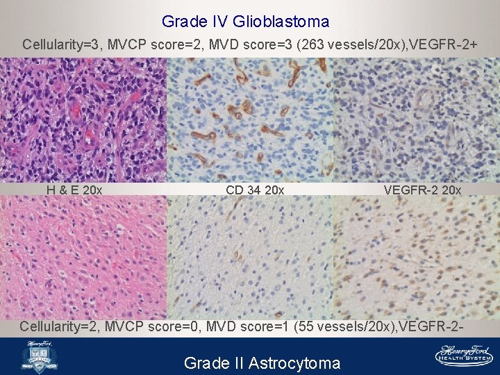 Grade IV Glioblastoma Cellularity=3, MVCP score=2, MVD score=3 (263 vessels/20 x), VEGFR-2+ H &