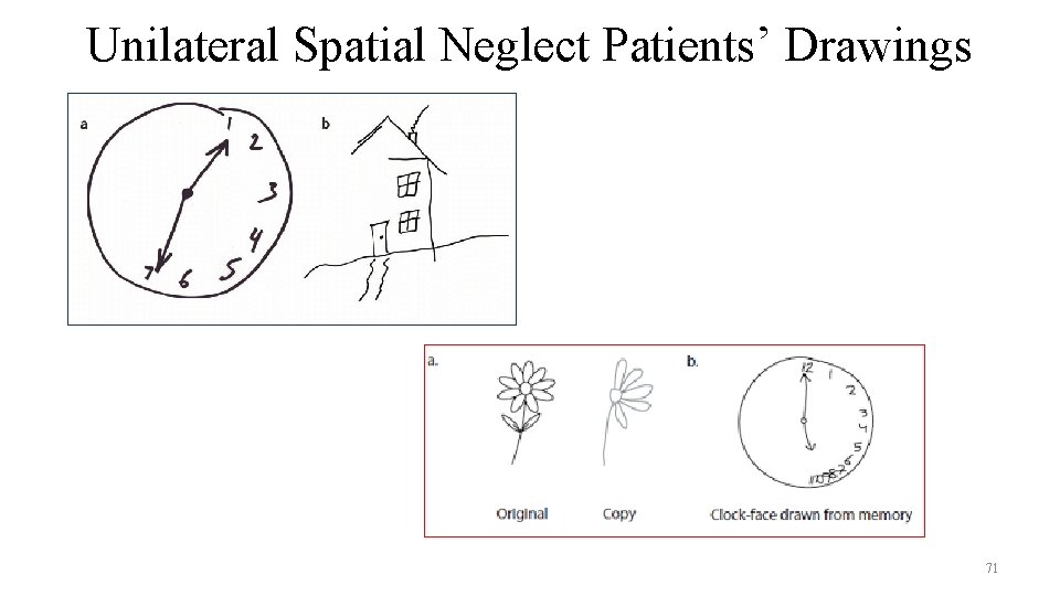 Unilateral Spatial Neglect Patients’ Drawings 71 