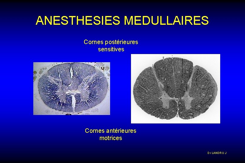 ANESTHESIES MEDULLAIRES Cornes postérieures sensitives Cornes antérieures motrices Dr LANDRU J 