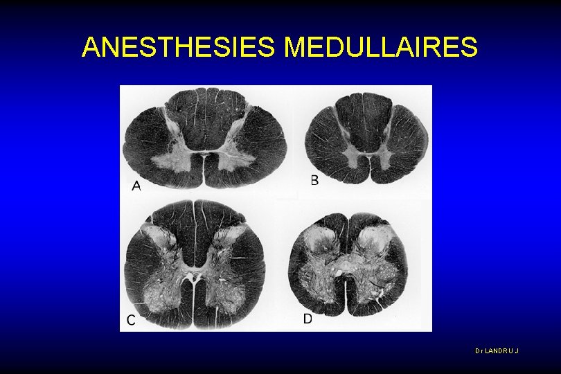 ANESTHESIES MEDULLAIRES Dr LANDRU J 