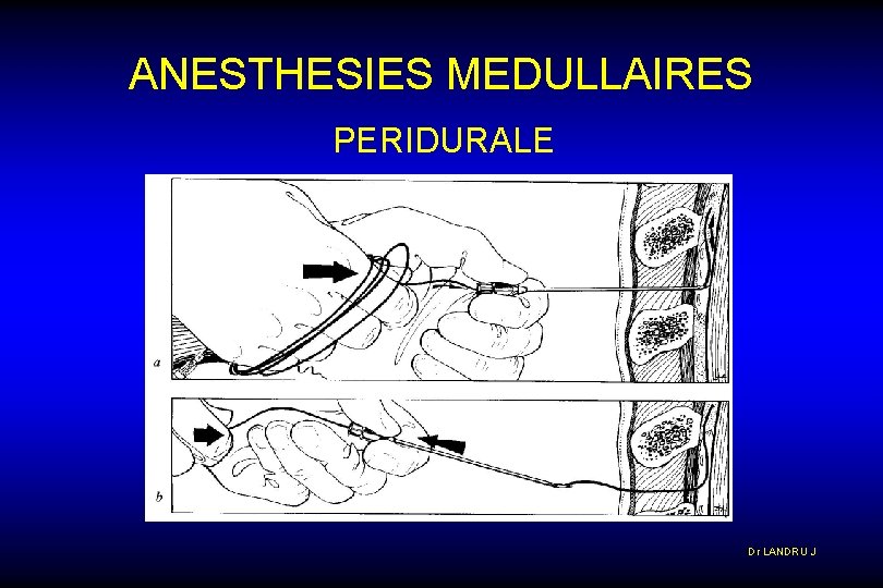 ANESTHESIES MEDULLAIRES PERIDURALE Dr LANDRU J 