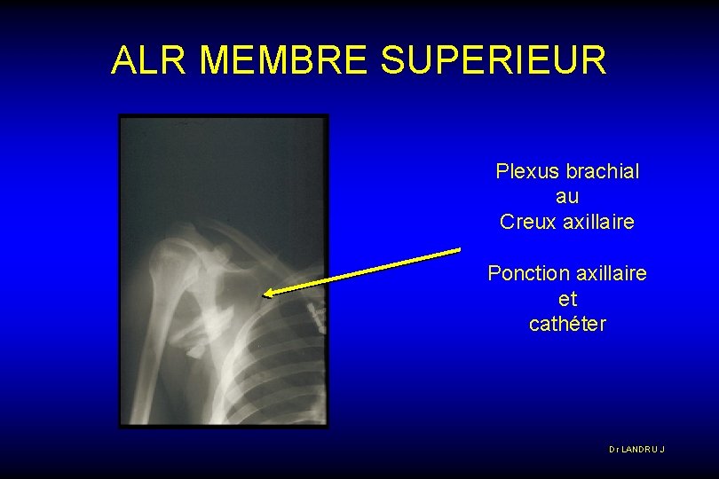 ALR MEMBRE SUPERIEUR Plexus brachial au Creux axillaire Ponction axillaire et cathéter Dr LANDRU