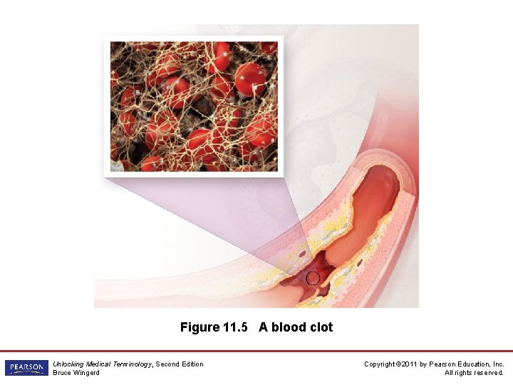 Figure 11. 5 A blood clot Unlocking Medical Terminology, Second Edition Bruce Wingerd Copyright