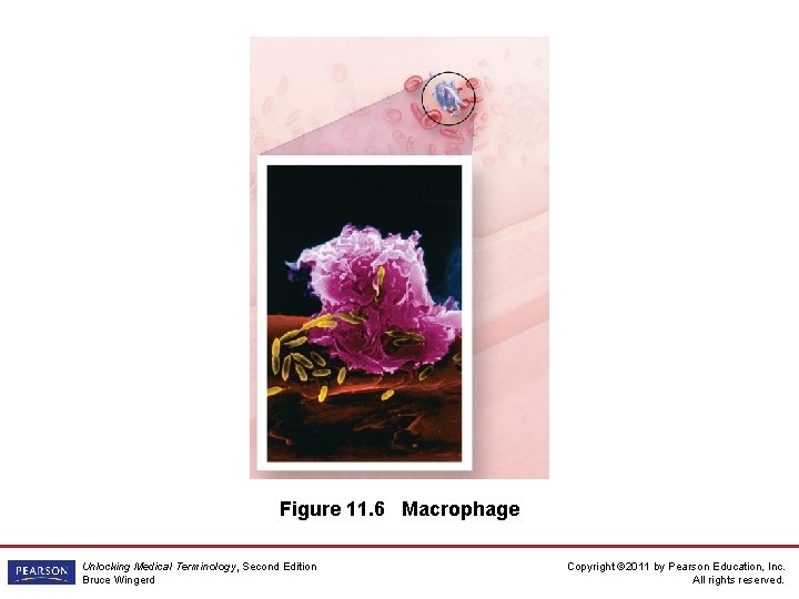 Figure 11. 6 Macrophage Unlocking Medical Terminology, Second Edition Bruce Wingerd Copyright © 2011