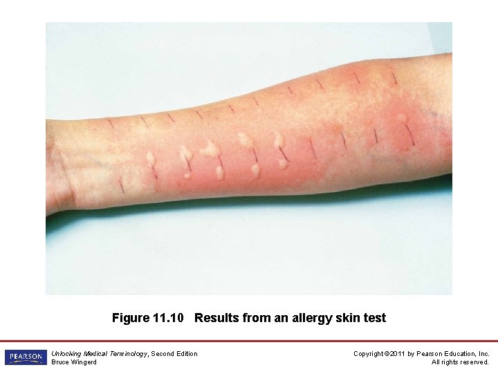 Figure 11. 10 Results from an allergy skin test Unlocking Medical Terminology, Second Edition
