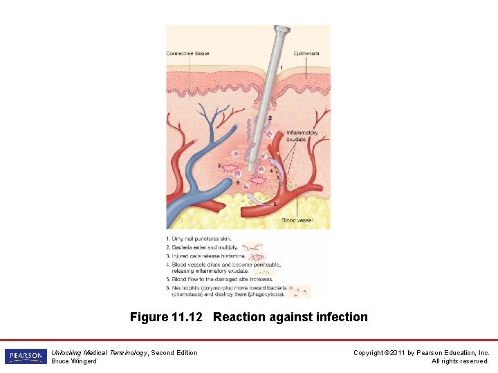 Figure 11. 12 Reaction against infection Unlocking Medical Terminology, Second Edition Bruce Wingerd Copyright