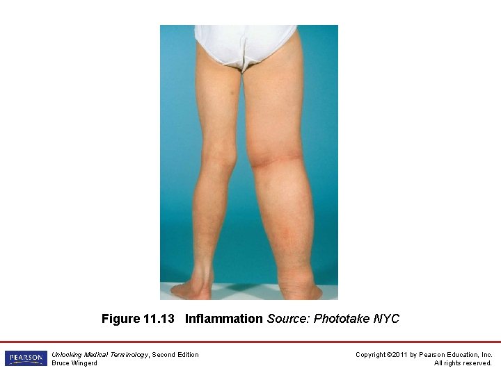 Figure 11. 13 Inflammation Source: Phototake NYC Unlocking Medical Terminology, Second Edition Bruce Wingerd