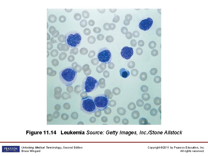 Figure 11. 14 Leukemia Source: Getty Images, Inc. /Stone Allstock Unlocking Medical Terminology, Second