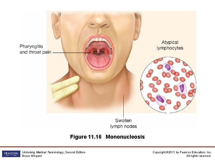Figure 11. 16 Mononucleosis Unlocking Medical Terminology, Second Edition Bruce Wingerd Copyright © 2011
