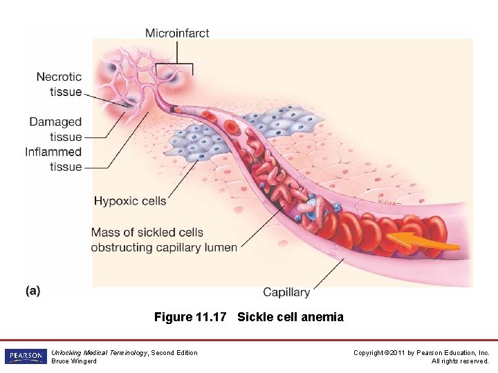 Figure 11. 17 Sickle cell anemia Unlocking Medical Terminology, Second Edition Bruce Wingerd Copyright