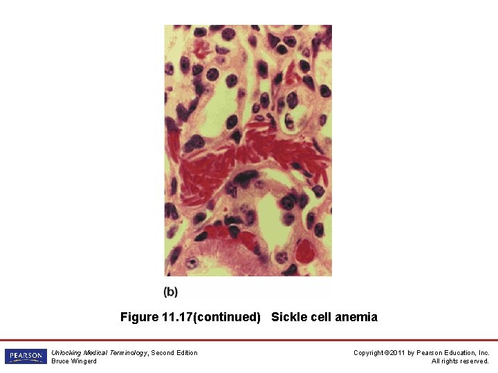 Figure 11. 17(continued) Sickle cell anemia Unlocking Medical Terminology, Second Edition Bruce Wingerd Copyright