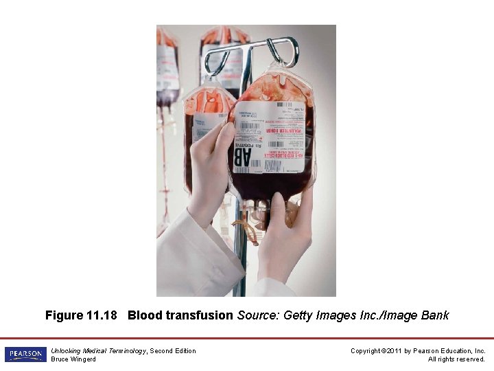 Figure 11. 18 Blood transfusion Source: Getty Images Inc. /Image Bank Unlocking Medical Terminology,