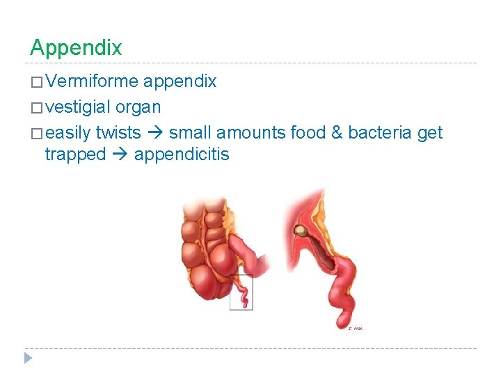 Appendix � Vermiforme appendix � vestigial organ � easily twists small amounts food &