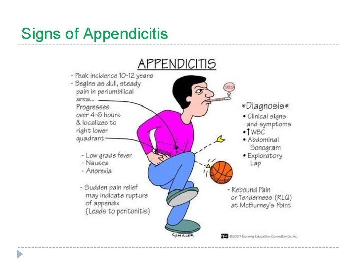 Signs of Appendicitis 