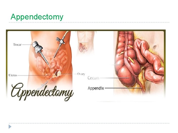 Appendectomy 