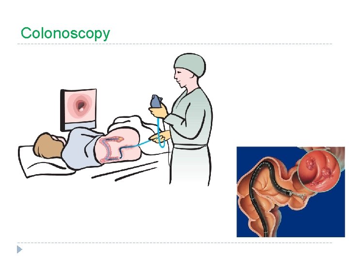 Colonoscopy 