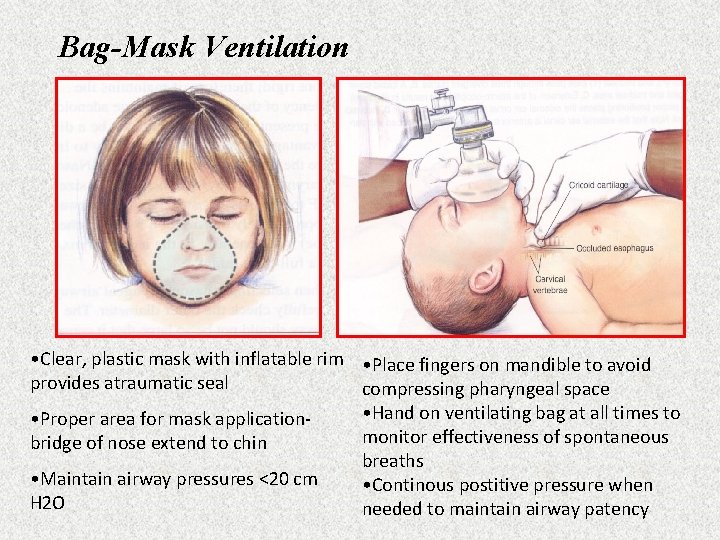 Bag-Mask Ventilation • Clear, plastic mask with inflatable rim • Place fingers on mandible