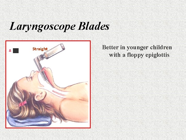 Laryngoscope Blades Straight Better in younger children with a floppy epiglottis 