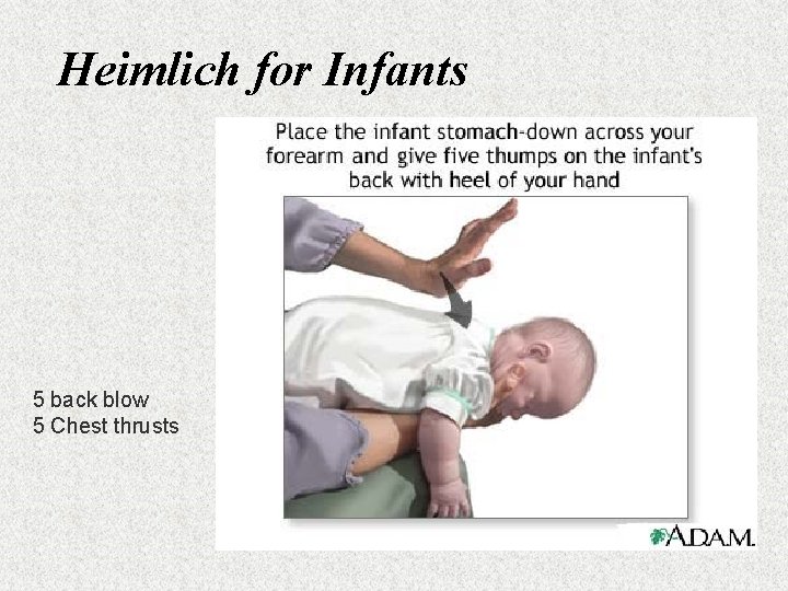 Heimlich for Infants 5 back blow 5 Chest thrusts 