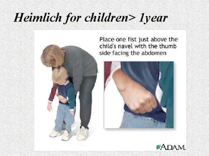 Heimlich for children> 1 year 