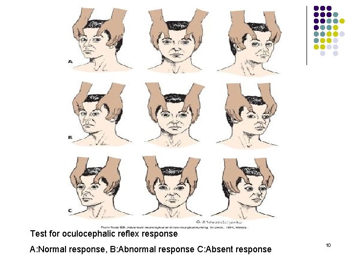 Test for oculocephalic reflex response A: Normal response, B: Abnormal response C: Absent response