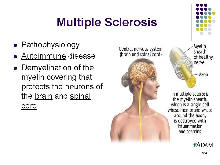 Multiple Sclerosis l l l Pathophysiology Autoimmune disease Demyelination of the myelin covering that