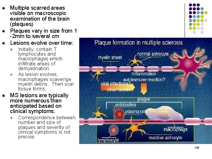 l l l Multiple scarred areas visible on macroscopic examination of the brain (plaques)