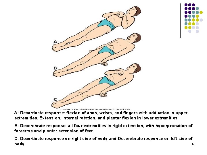 A: Decorticate response: flexion of arms, wrists, and fingers with adduction in upper extremities.