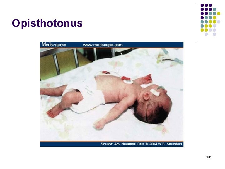 Opisthotonus 135 