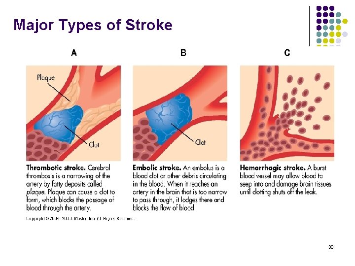 Major Types of Stroke 30 